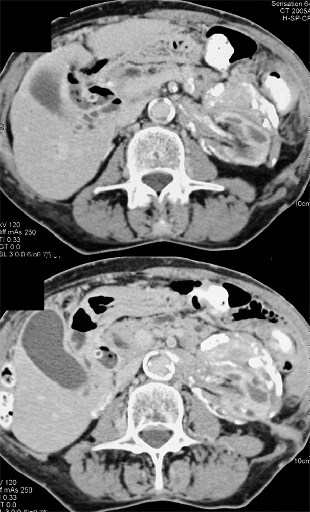 CT of the Perirenal Space