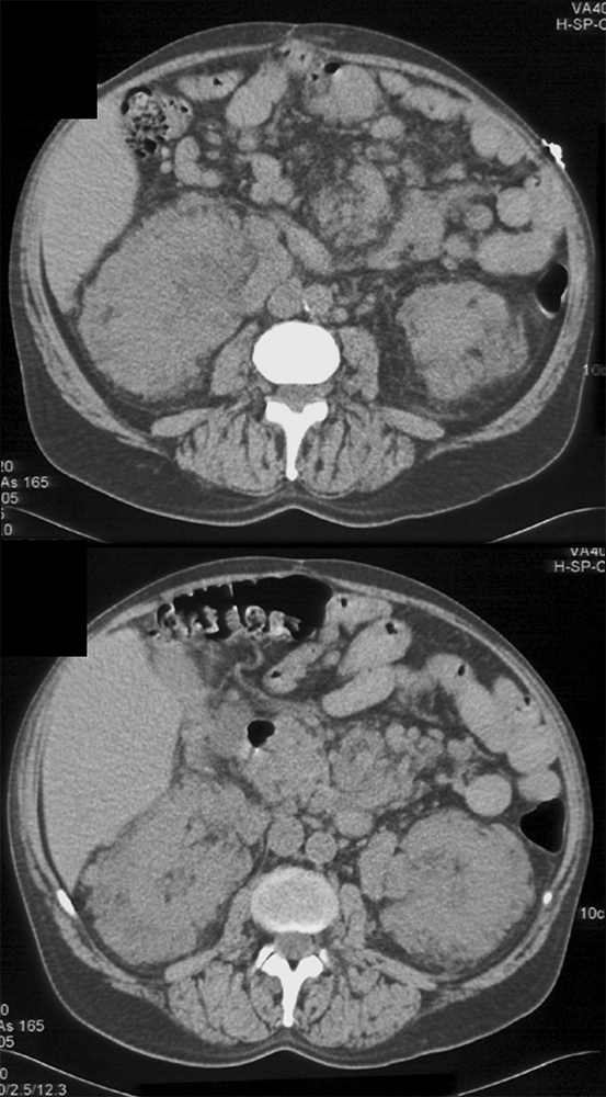 Extramedullary Hematopoiesis