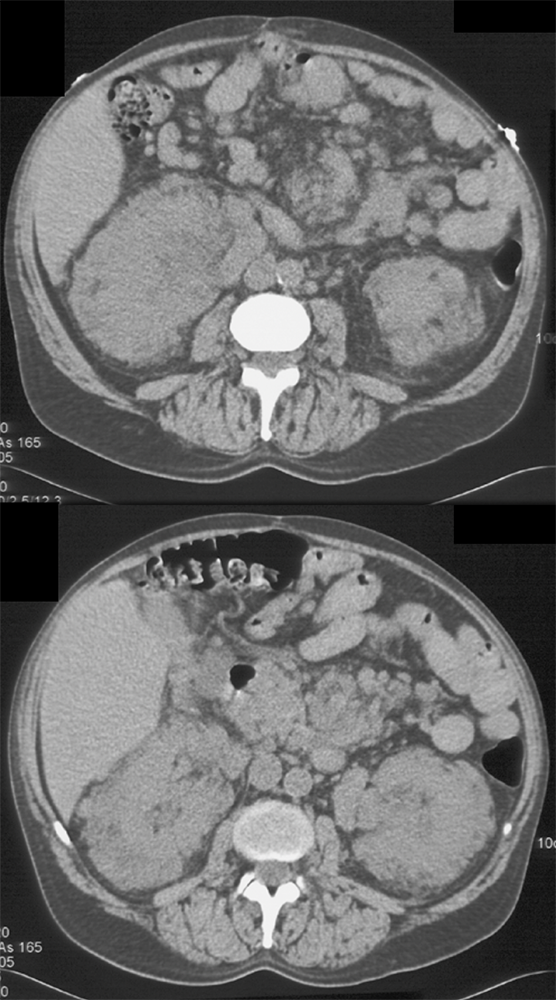 Extramedullary Hematopoiesis in Perirenal Space and Mesentery