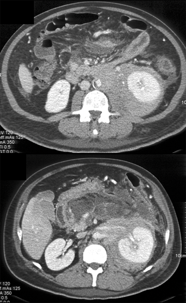 Perirenal Lymphoma