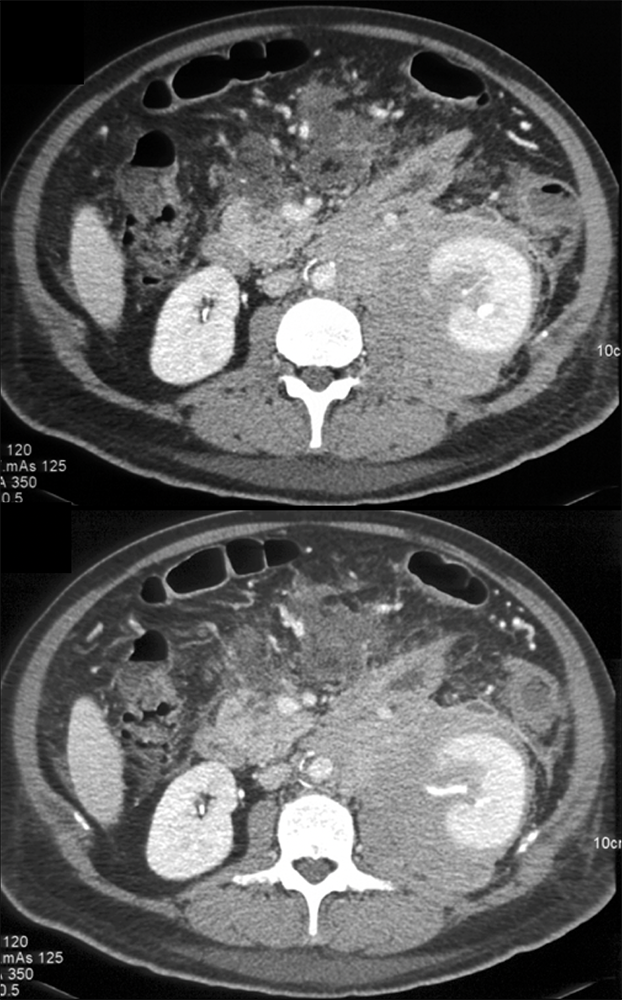 CT of the Perirenal Space