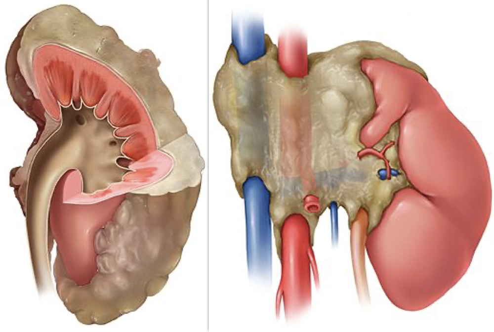 Renal Lymphoma