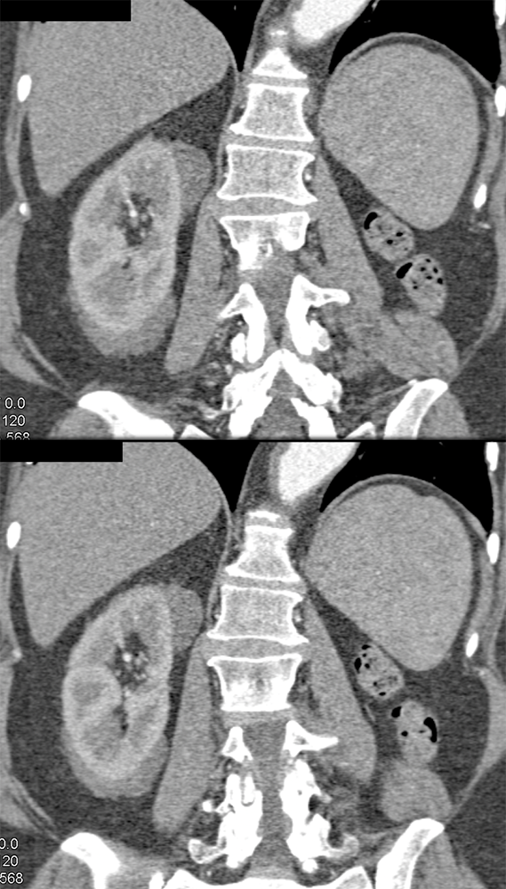 Perirenal Lymphoma