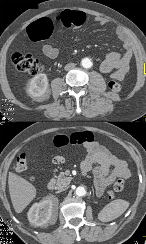 Perirenal Lymphoma