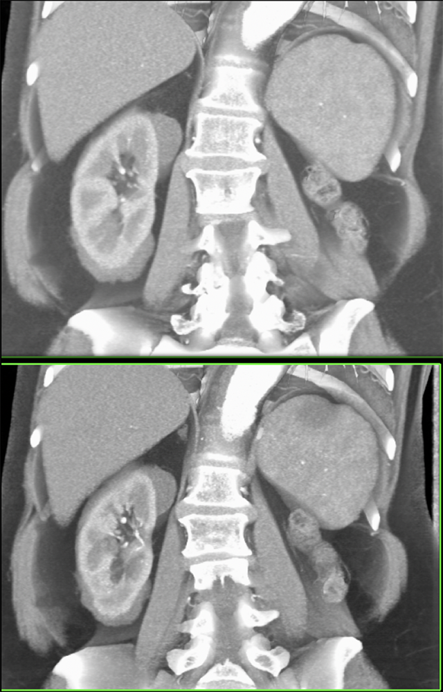 CT of the Perirenal Space