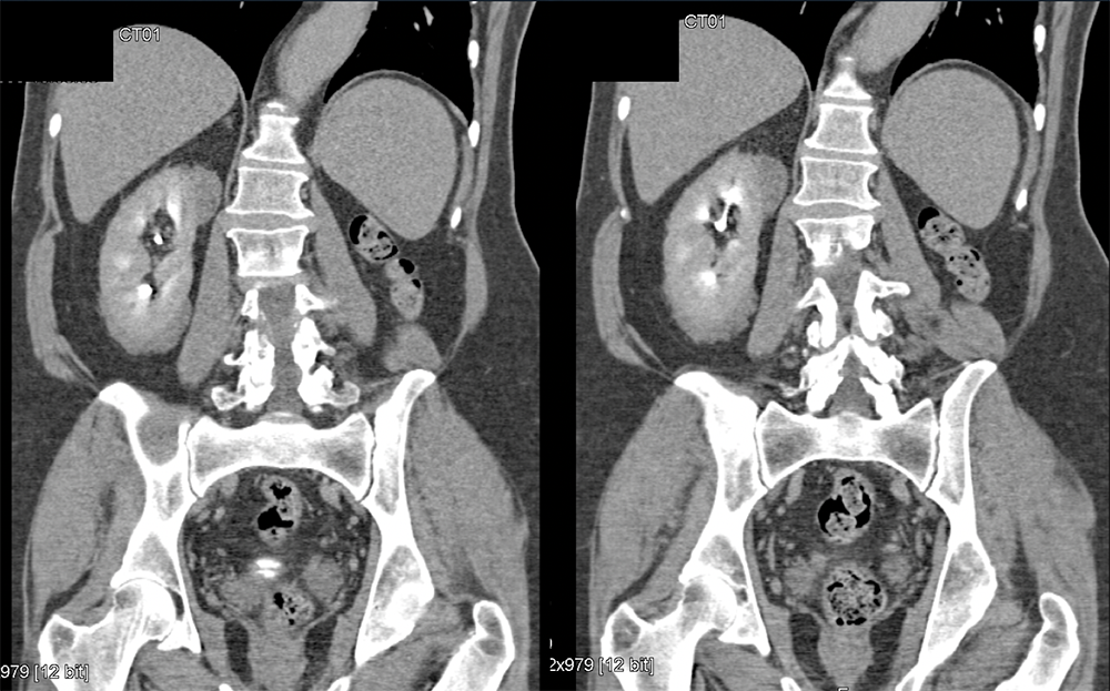 CT of the Perirenal Space