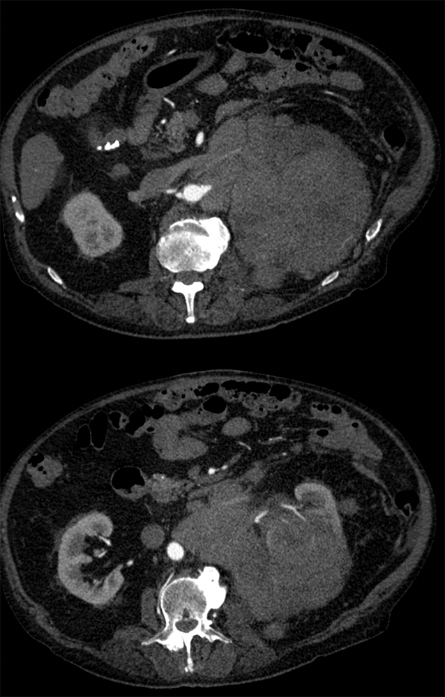 B-Cell Lymphoma