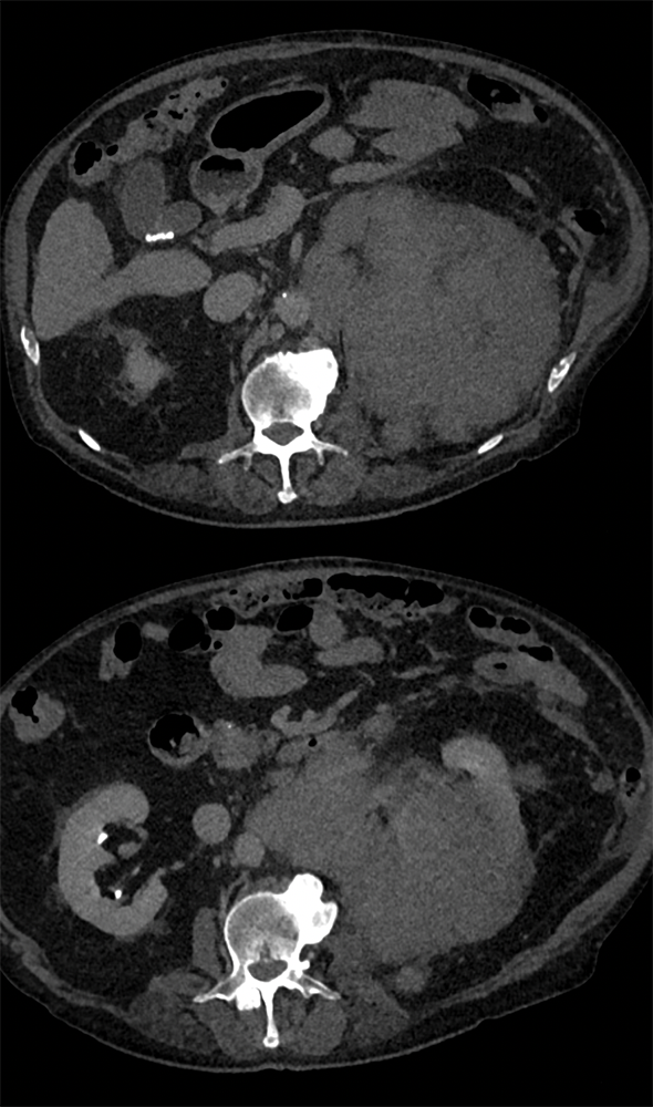 CT of the Perirenal Space