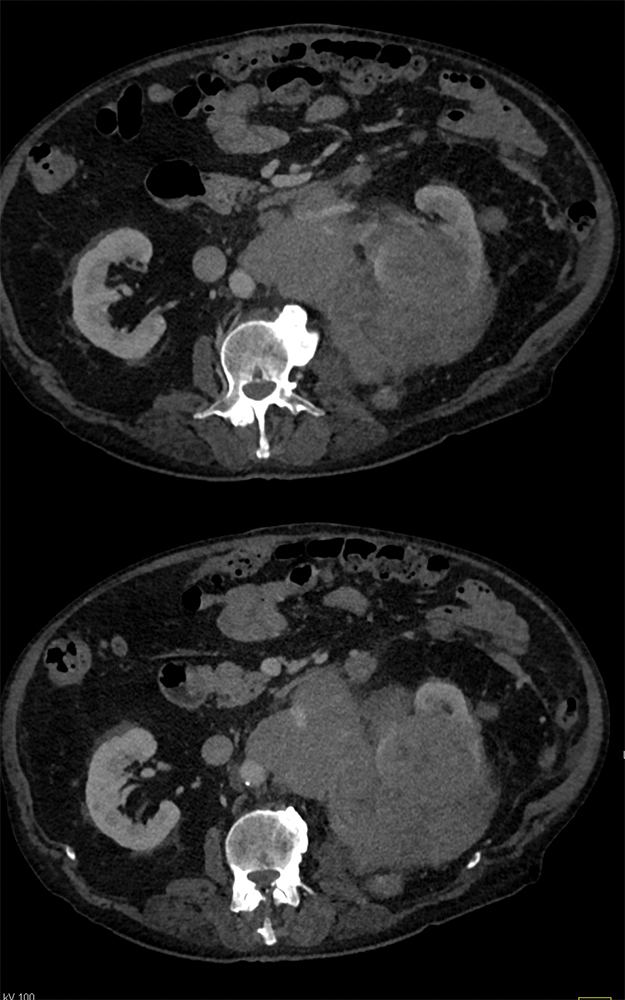 CT of the Perirenal Space