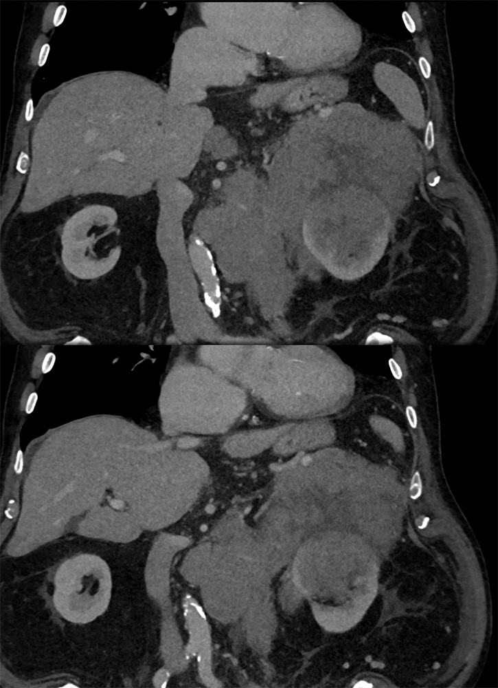 CT of the Perirenal Space