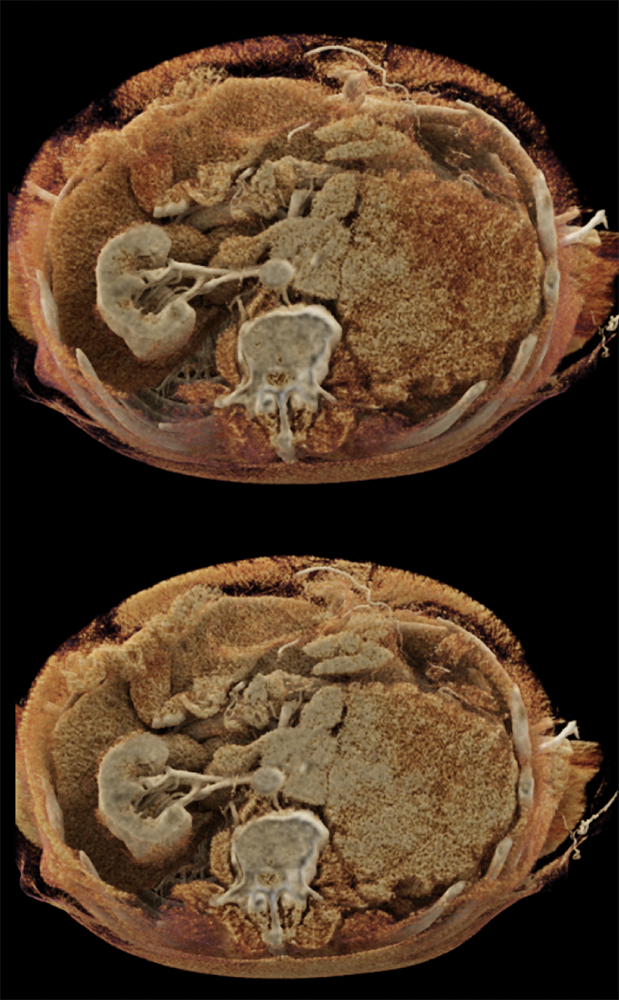 CT of the Perirenal Space