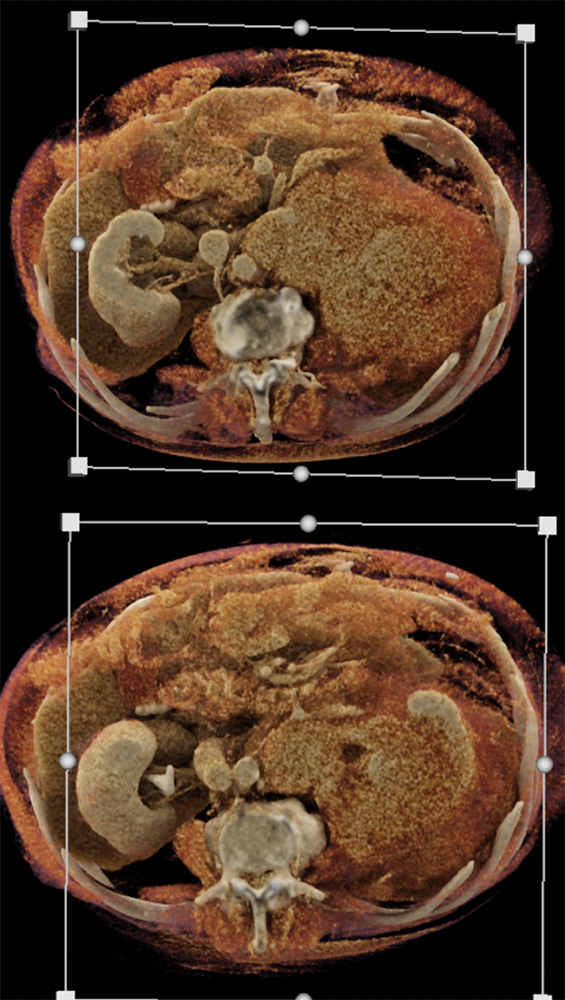 CT of the Perirenal Space