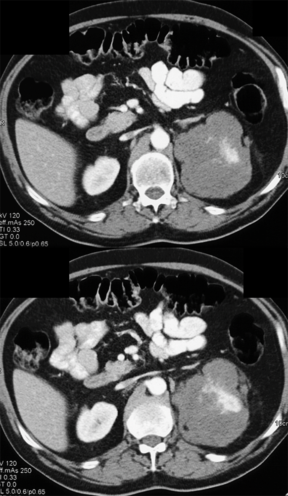 Renal Mass-Perirenal Lymphoma