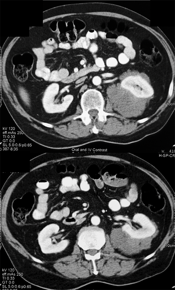 CT of the Perirenal Space