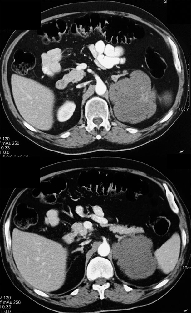 CT of the Perirenal Space