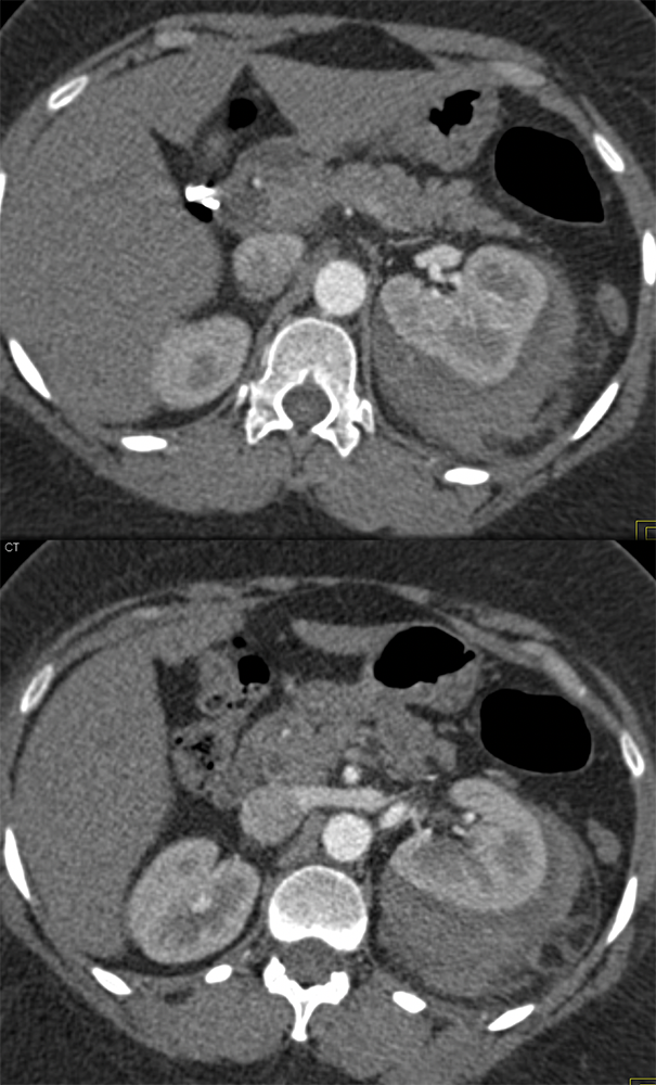 Renal Bx with Perirenal Bleed