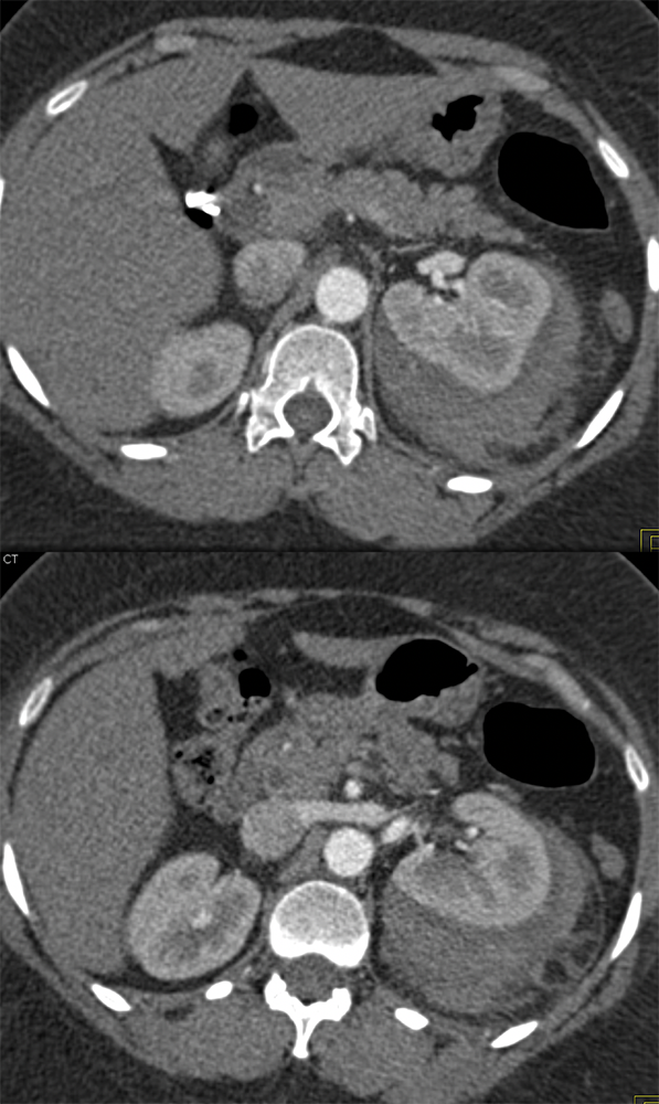 CT of the Perirenal Space