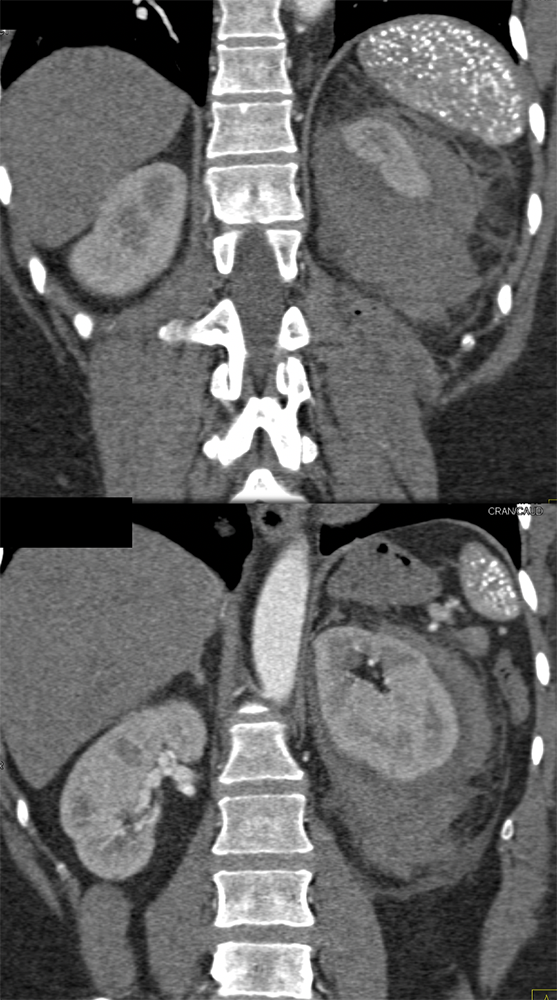 CT of the Perirenal Space