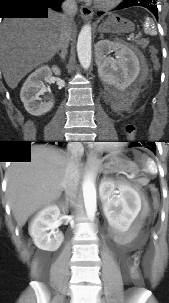 CT of the Perirenal Space