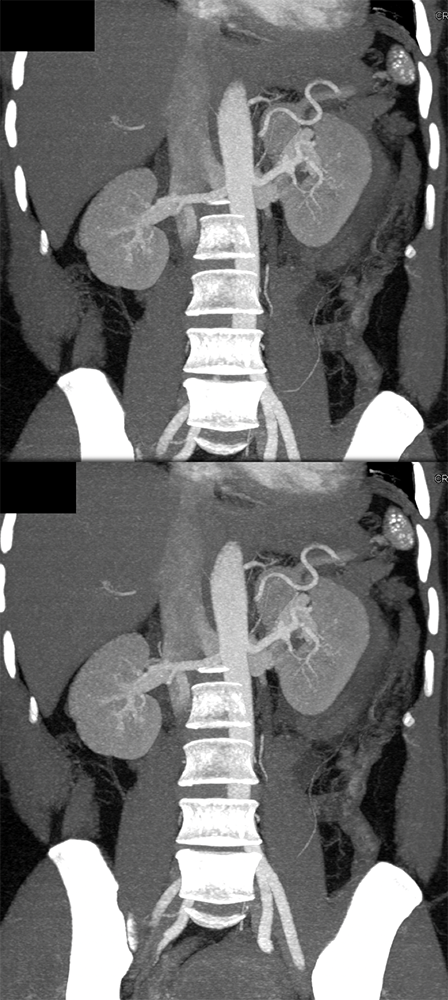 CT of the Perirenal Space