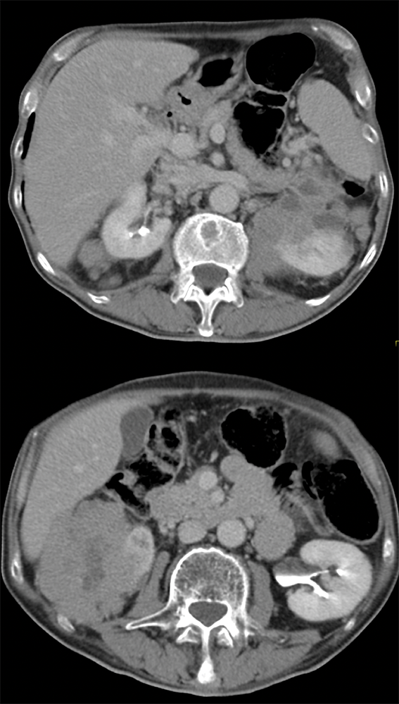 CT of the Perirenal Space