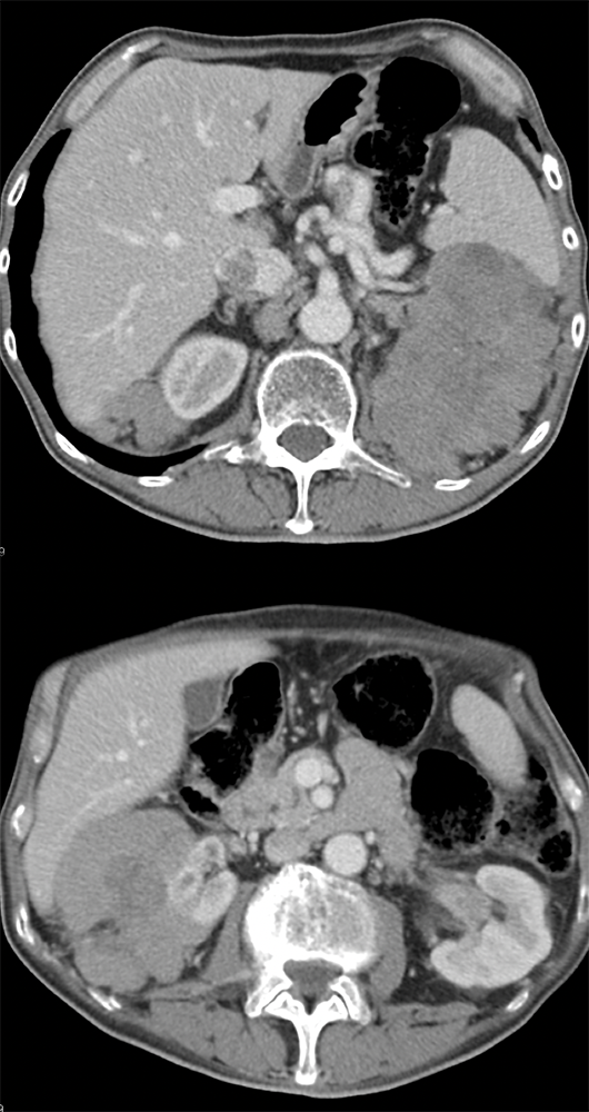 CT of the Perirenal Space