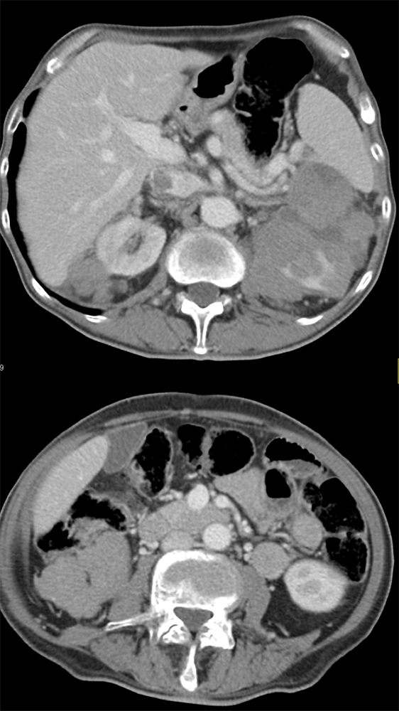 CT of the Perirenal Space