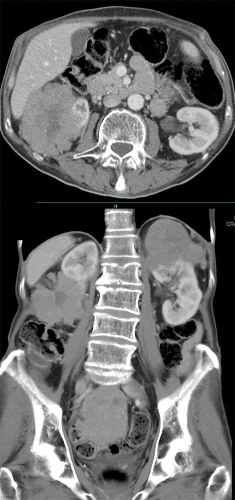 CT of the Perirenal Space