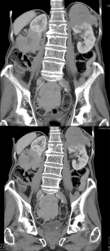 CT of the Perirenal Space