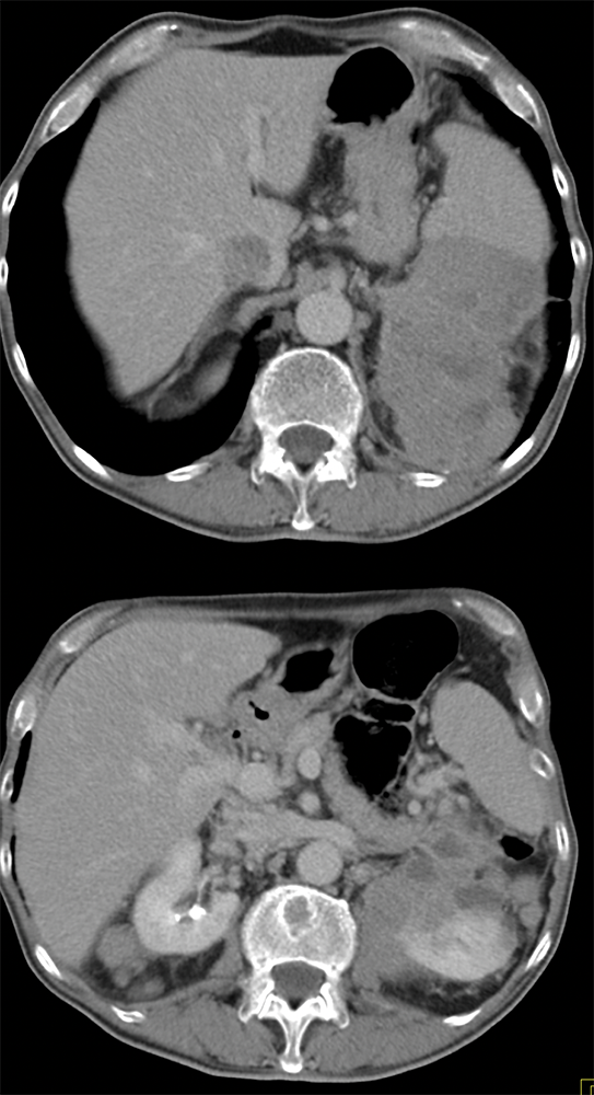 Perirenal Spread of Melanoma