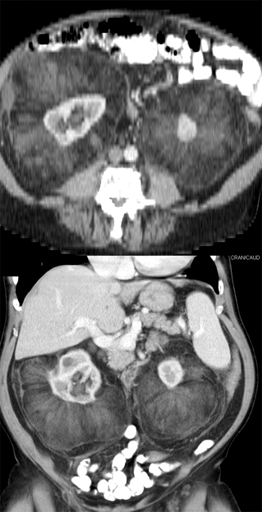 CT of the Perirenal Space