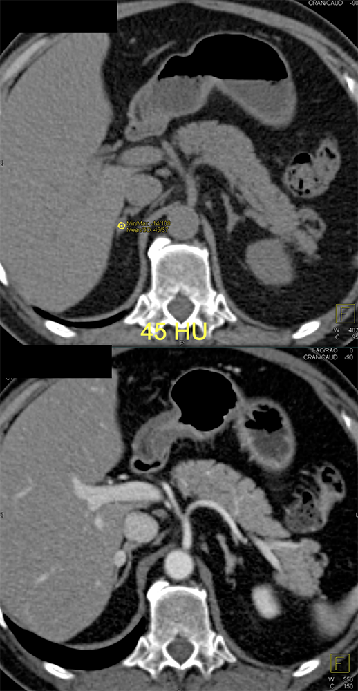 Adrenal Pheochromocytoma