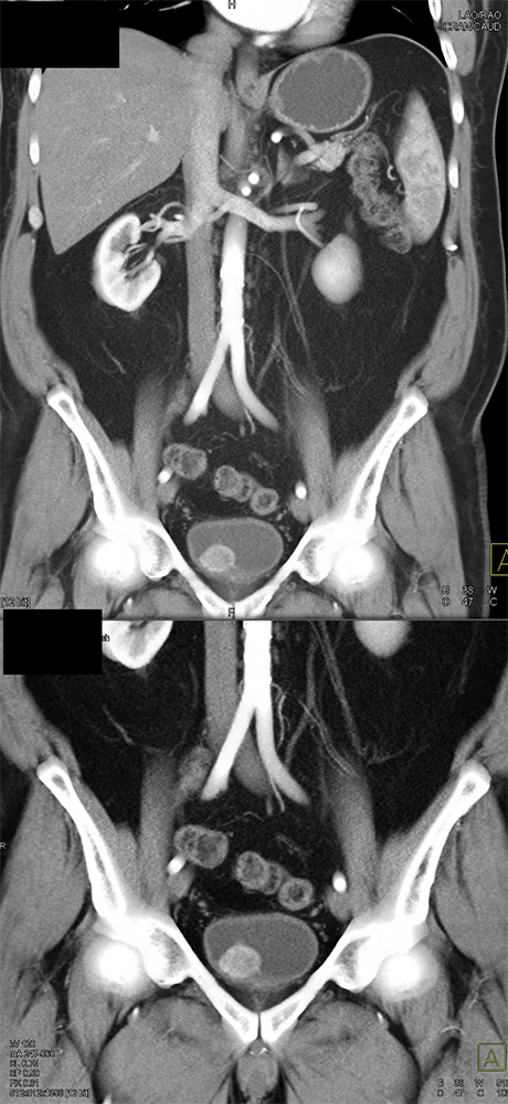 Adrenal Pheochromocytoma