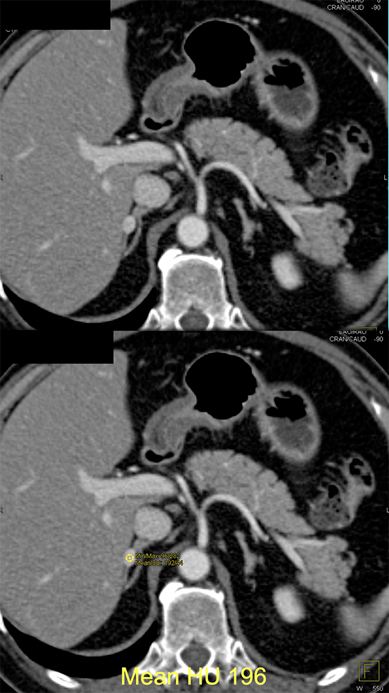 Adrenal Pheochromocytoma