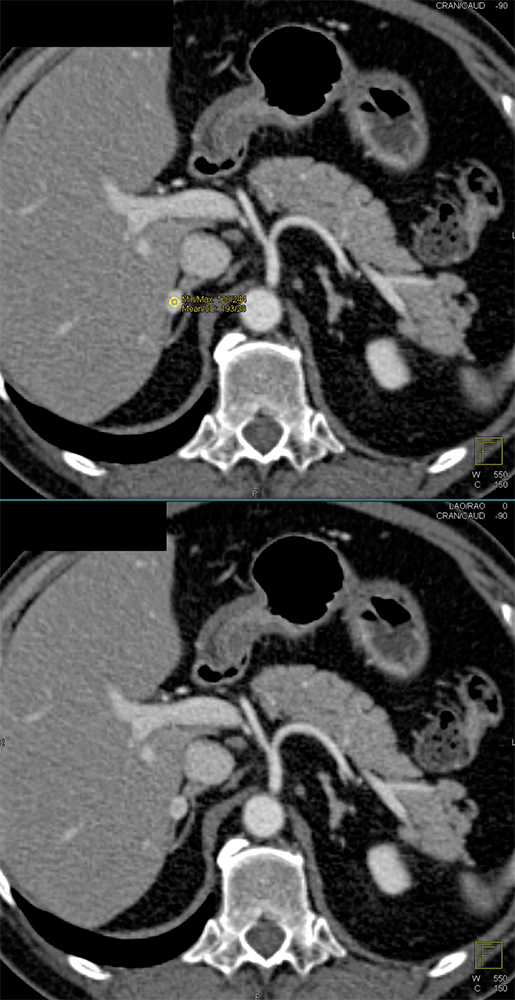 Adrenal Pheochromocytoma