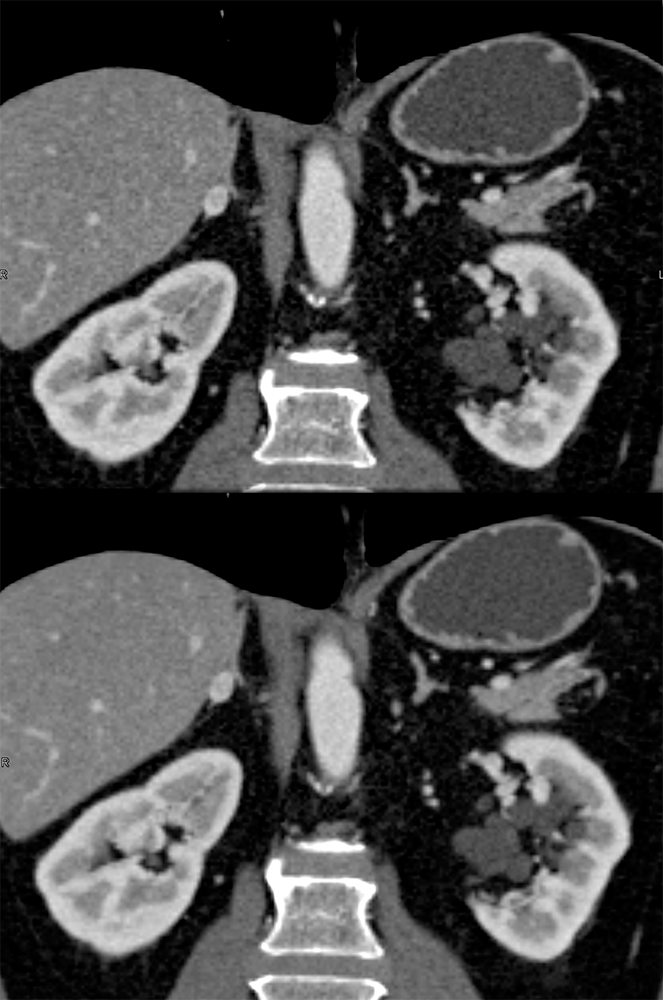 Adrenal Pheochromocytoma