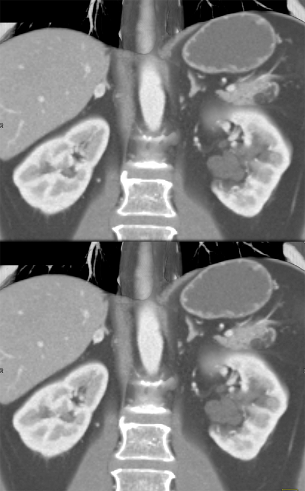 Adrenal Pheochromocytoma