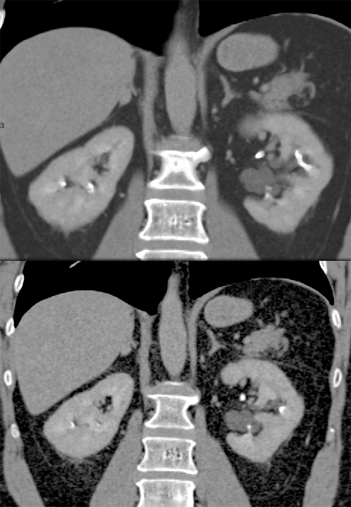 Adrenal Pheochromocytoma