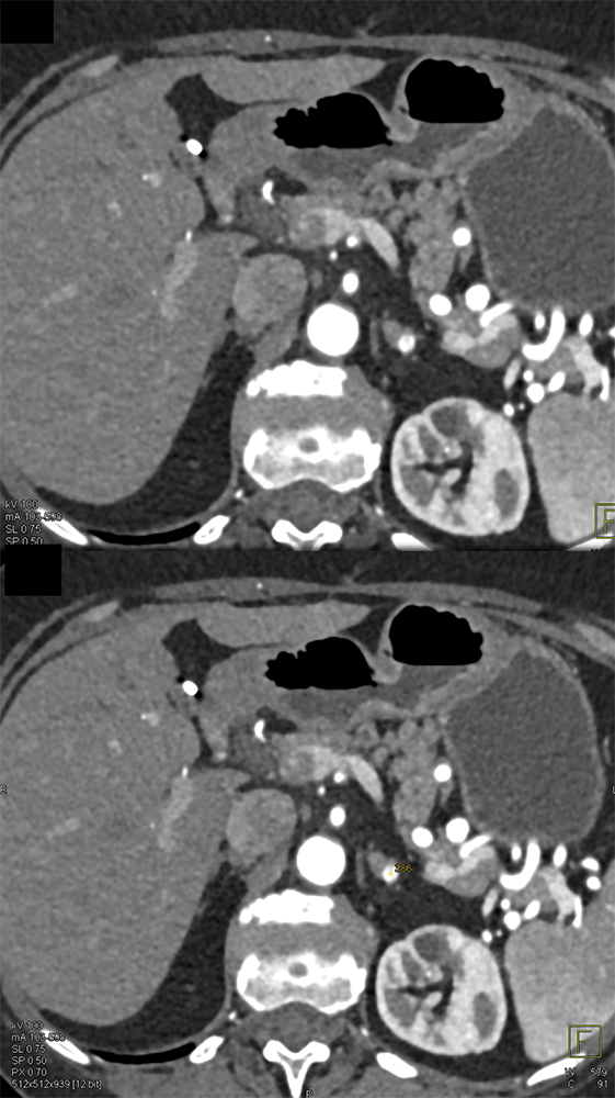 Pheo Left Adrenal