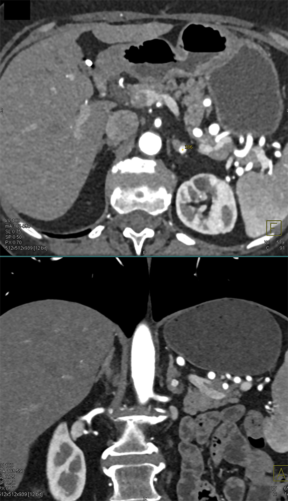 Adrenal Pheochromocytoma