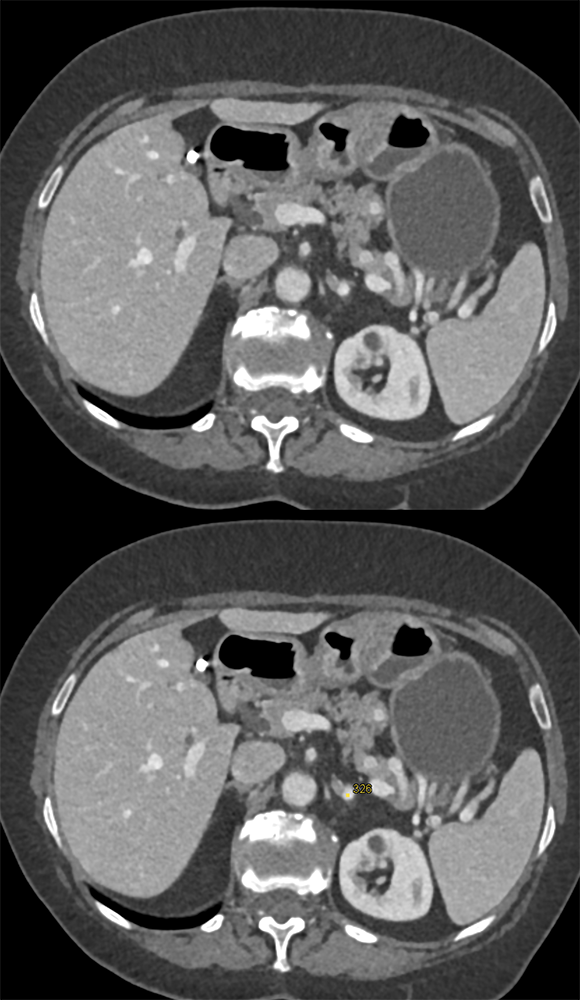 Adrenal Pheochromocytoma