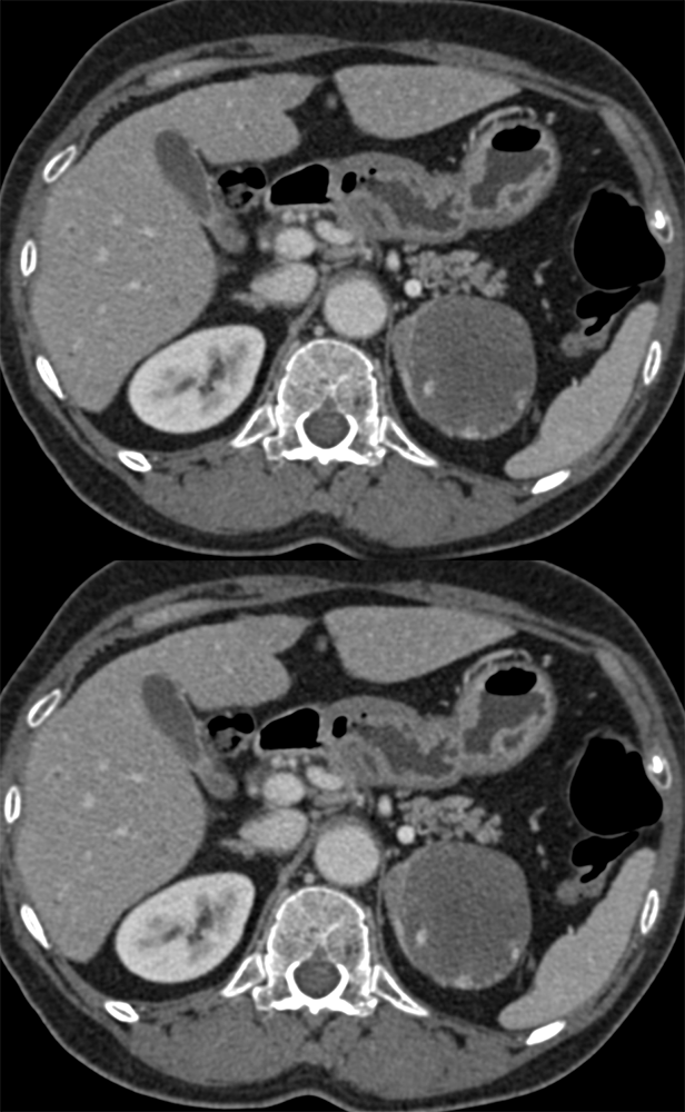 Adrenal Pheochromocytoma