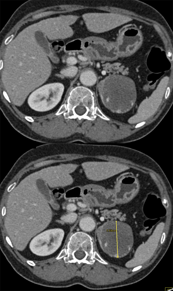 Adrenal Pheochromocytoma