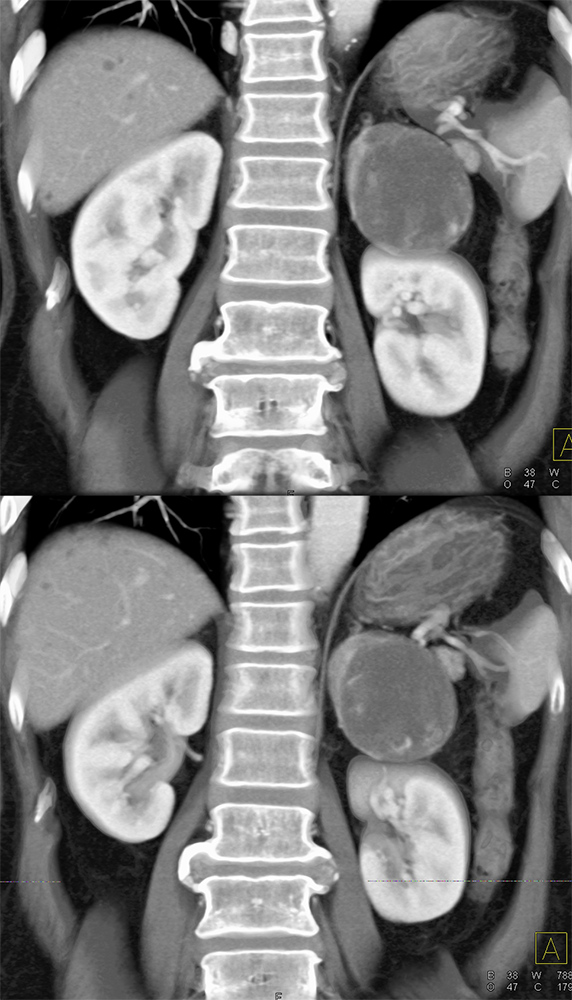 Adrenal Pheochromocytoma