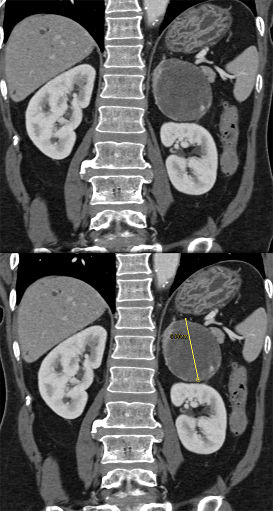 Adrenal Pheochromocytoma