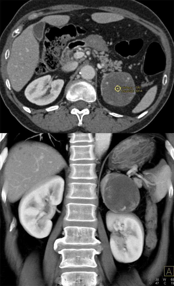 Adrenal Pheochromocytoma