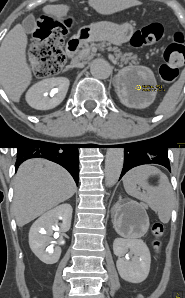 Adrenal Pheochromocytoma