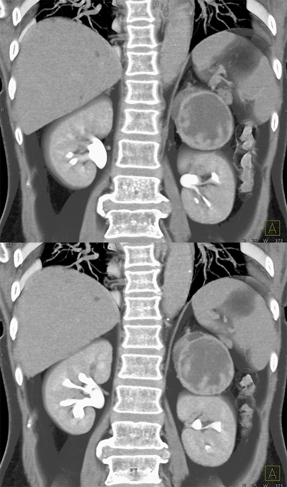 Adrenal Pheochromocytoma