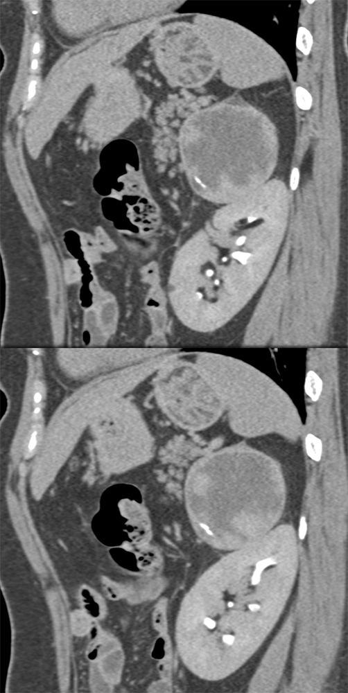 Adrenal Pheochromocytoma