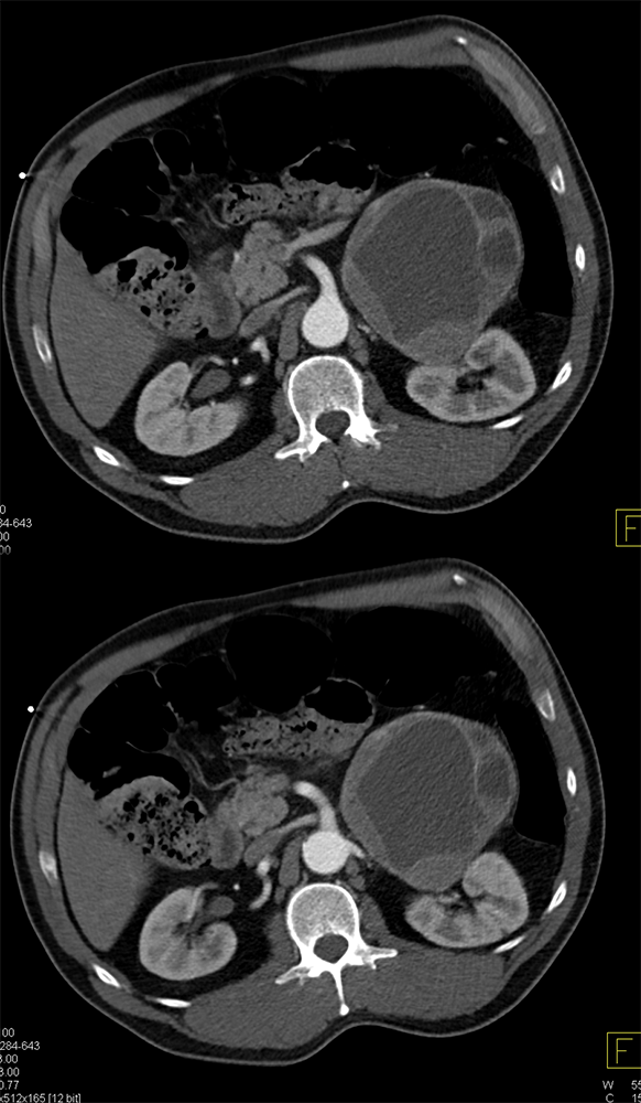 Phechromocytoma (7.2cm)